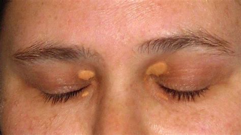 What Causes Cholesterol Bumps On Eyelids
